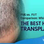 FUE vs FUT Comparison Which One is the Best Hair Transplant Featured Image YMM
