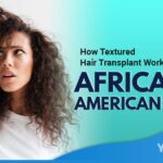 How Textured Hair Transplant Work For African American Hair Featured Image YMM