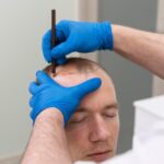 Scalp Micropigmentation Hair Loss Treatment