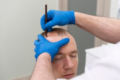 Scalp Micropigmentation Hair Loss Treatment